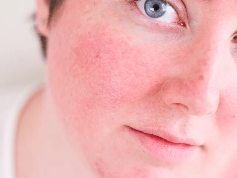 Rosácea, você conhece?